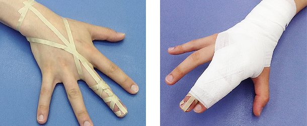 骨折 突き指 違い と の 突き指と骨折の見分け方。症状にどんな違いがある？治療法や期間は？